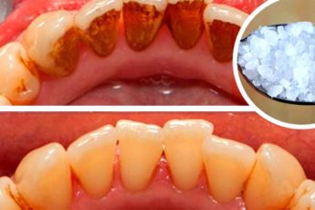 ეს საშუალება ძალიან გაყვითლებულ კბილებსაც გაათეთრებს და კბილის ქვას მოგაშორებთ. შესანიშნავი ეფექტი
