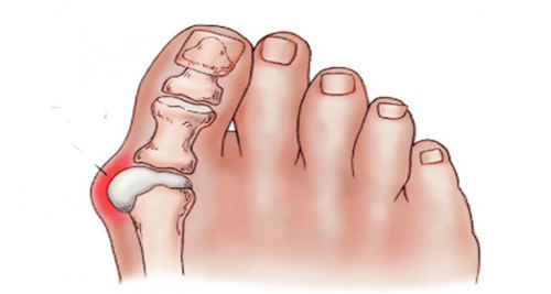 ძვალი ფეხზე - ძალიან მტკივნეული დაავადება, რომელსაც მარტივად მოიშორებთ ამ ორი საშუალებით...