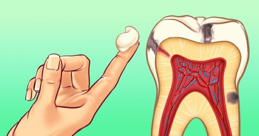 კბილის ტკივილის გამაყუჩებელი საშუალებები: რომელი საშუალება გვეხმარება და რომელი გვაყენებს ზიანს